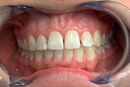 Dental Work Before and After - Invisalign