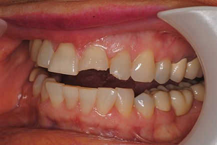 Dental Work Before and After - Composite Fillings
