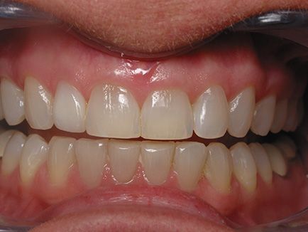 Dental Work Before and After - Veneers Crowns