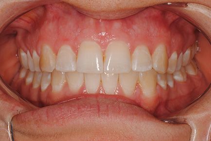 Dental Work Before and After - Invisalign