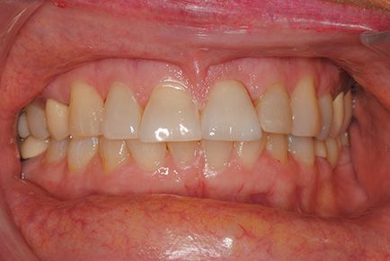 Dental Work Before and After - Composite Fillings