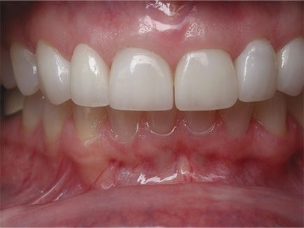 Dental Work Before and After - Veneers Crowns